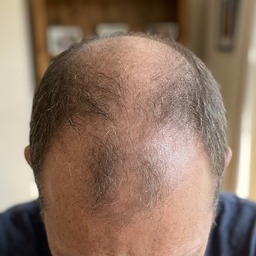Mike R. — scalp after first HS-01 session