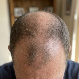 Mike R. — hairline progress