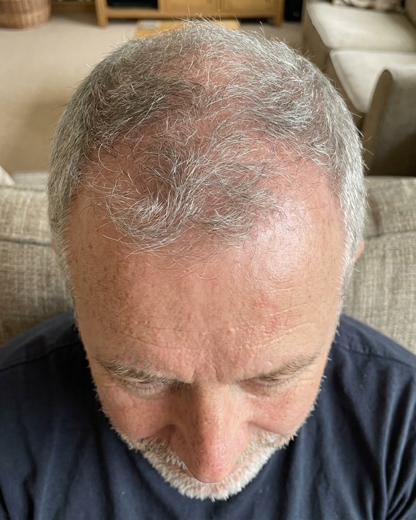 Tom B. — hairline regrowth at week 8