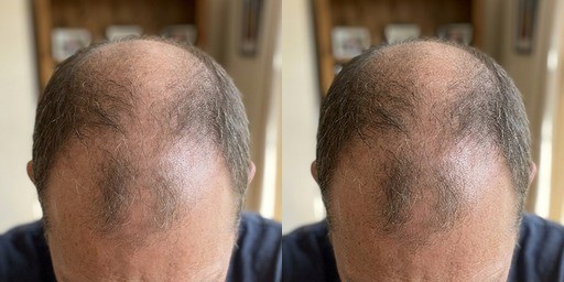 Mike R. — hairline regrowth at week 1